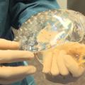 Βίντεο από την πρώτη ολική μεταμόσχευση «εκτυπωμένου» κρανίου παγκοσμίως